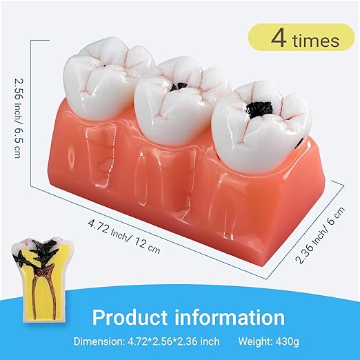 4X Caries Tooth Disassembly Model Tooth Model Caries Evolution Model for Doctor-Patient Communication, Dentist Education and Practice