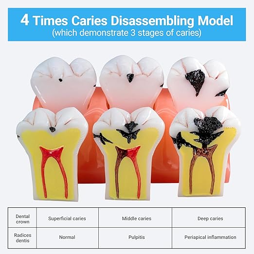 4X Caries Tooth Disassembly Model Tooth Model Caries Evolution Model for Doctor-Patient Communication, Dentist Education and Practice