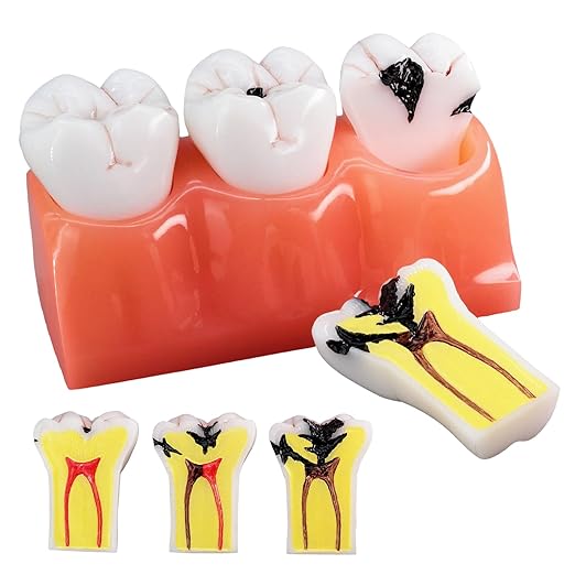 4X Caries Tooth Disassembly Model Tooth Model Caries Evolution Model for Doctor-Patient Communication, Dentist Education and Practice